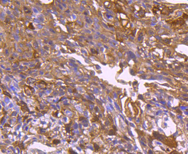 Immunohistochemical analysis of paraffin-embedded human colon carcinoma tissue using anti-Hsp27 antibody. The section was pre-treated using heat mediated antigen retrieval with Tris-EDTA buffer (pH 8.0-8.4) for 20 minutes.The tissues were blocked in 5% BSA for 30 minutes at room temperature, washed with ddH2O and PBS, and then probed with the primary antibody (ET1701-70, 1/50) for 30 minutes at room temperature. The detection was performed using an HRP conjugated compact polymer system. DAB was used as the chromogen. Tissues were counterstained with hematoxylin and mounted with DPX.