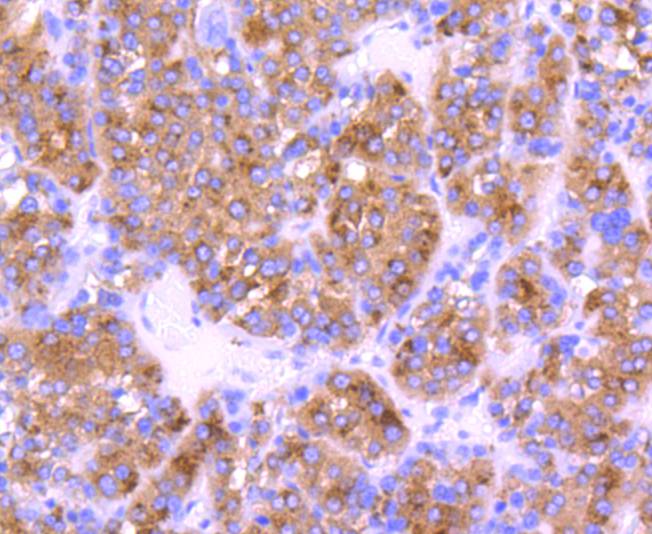 Immunohistochemical analysis of paraffin-embedded human liver carcinoma tissue using anti-Cystatin C antibody. The section was pre-treated using heat mediated antigen retrieval with Tris-EDTA buffer (pH 9.0) for 20 minutes.The tissues were blocked in 5% BSA for 30 minutes at room temperature, washed with ddH2O and PBS, and then probed with the primary antibody (ET1701-72, 1/50) for 30 minutes at room temperature. The detection was performed using an HRP conjugated compact polymer system. DAB was used as the chromogen. Tissues were counterstained with hematoxylin and mounted with DPX.