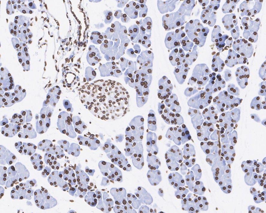 Immunohistochemical analysis of paraffin-embedded human breast carcinoma tissue using anti-E2F1 antibody. The section was pre-treated using heat mediated antigen retrieval with sodium citrate buffer (pH 6.0) for 20 minutes. The tissues were blocked in 5% BSA for 30 minutes at room temperature, washed with ddH2O and PBS, and then probed with the primary antibody (ET1701-73, 1/50)  for 30 minutes at room temperature. The detection was performed using an HRP conjugated compact polymer system. DAB was used as the chromogen. Tissues were counterstained with hematoxylin and mounted with DPX.