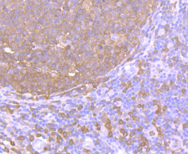 Immunohistochemical analysis of paraffin-embedded human tonsil tissue using anti-PKC delta antibody. The section was pre-treated using heat mediated antigen retrieval with Tris-EDTA buffer (pH 8.0-8.4) for 20 minutes.The tissues were blocked in 5% BSA for 30 minutes at room temperature, washed with ddH2O and PBS, and then probed with the primary antibody (ET1701-85, 1/50) for 30 minutes at room temperature. The detection was performed using an HRP conjugated compact polymer system. DAB was used as the chromogen. Tissues were counterstained with hematoxylin and mounted with DPX.