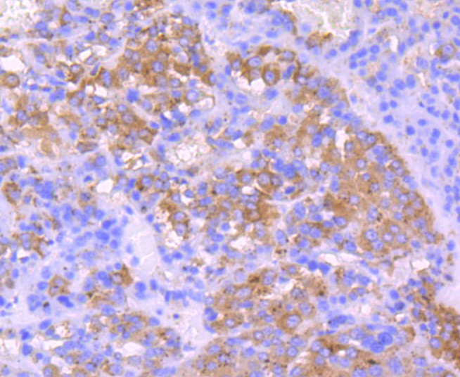 Immunohistochemical analysis of paraffin-embedded human liver carcinoma tissue using anti-IGF2 antibody. The section was pre-treated using heat mediated antigen retrieval with Tris-EDTA buffer (pH 9.0) for 20 minutes.The tissues were blocked in 1% BSA for 30 minutes at room temperature, washed with ddH2O and PBS, and then probed with the primary antibody (ET1701-88, 1/50) for 30 minutes at room temperature. The detection was performed using an HRP conjugated compact polymer system. DAB was used as the chromogen. Tissues were counterstained with hematoxylin and mounted with DPX.