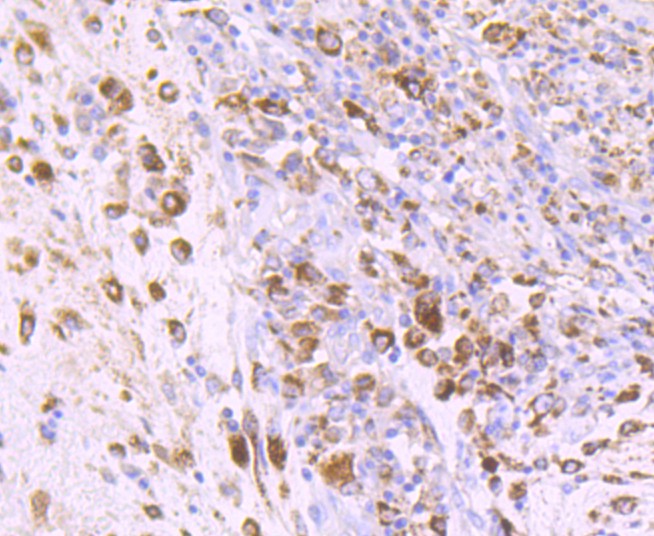 Immunohistochemical analysis of paraffin-embedded human colon carcinoma tissue using anti-IGF2 antibody. The section was pre-treated using heat mediated antigen retrieval with Tris-EDTA buffer (pH 9.0) for 20 minutes.The tissues were blocked in 1% BSA for 30 minutes at room temperature, washed with ddH2O and PBS, and then probed with the primary antibody (ET1701-88, 1/50) for 30 minutes at room temperature. The detection was performed using an HRP conjugated compact polymer system. DAB was used as the chromogen. Tissues were counterstained with hematoxylin and mounted with DPX.