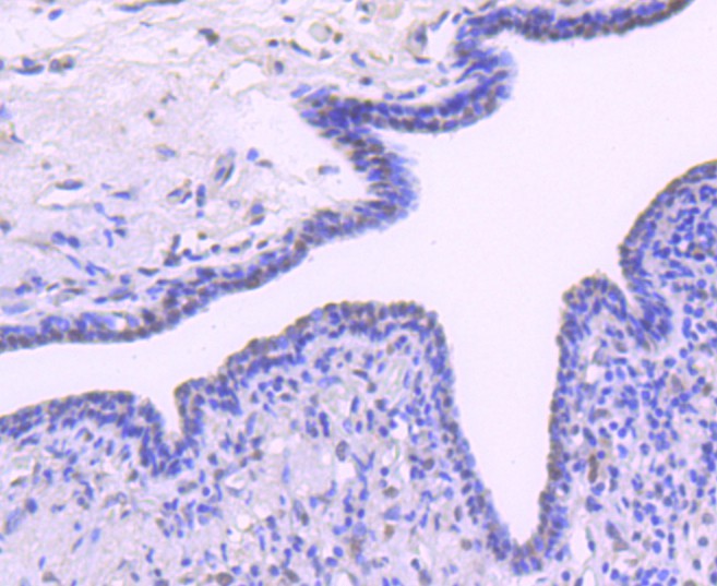Immunohistochemical analysis of paraffin-embedded human breast carcinoma tissue using anti-Bmi1 antibody. The section was pre-treated using heat mediated antigen retrieval with Tris-EDTA buffer (pH 8.0-8.4) for 20 minutes.The tissues were blocked in 5% BSA for 30 minutes at room temperature, washed with ddH2O and PBS, and then probed with the primary antibody (ET1701-89, 1/50) for 30 minutes at room temperature. The detection was performed using an HRP conjugated compact polymer system. DAB was used as the chromogen. Tissues were counterstained with hematoxylin and mounted with DPX.