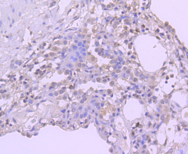 Immunohistochemical analysis of paraffin-embedded human lung carcinoma tissue using anti-Bmi1 antibody. The section was pre-treated using heat mediated antigen retrieval with Tris-EDTA buffer (pH 8.0-8.4) for 20 minutes.The tissues were blocked in 5% BSA for 30 minutes at room temperature, washed with ddH2O and PBS, and then probed with the primary antibody (ET1701-89, 1/50) for 30 minutes at room temperature. The detection was performed using an HRP conjugated compact polymer system. DAB was used as the chromogen. Tissues were counterstained with hematoxylin and mounted with DPX.