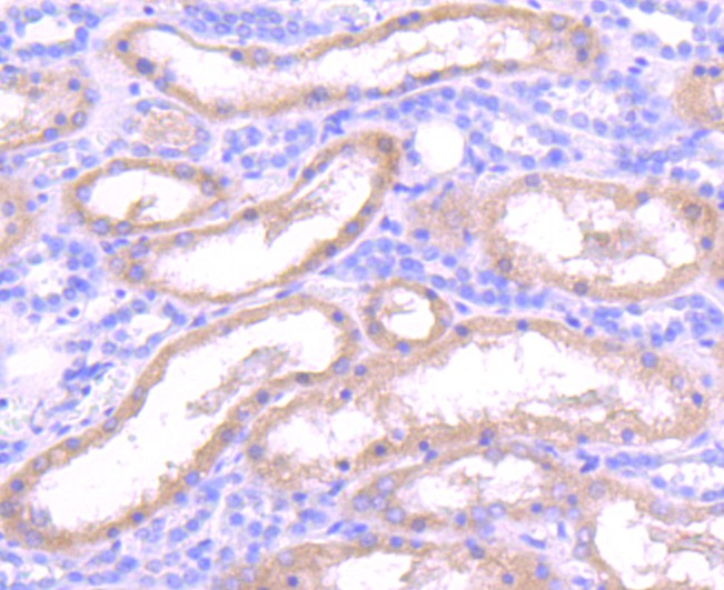 Immunohistochemical analysis of paraffin-embedded human liver carcinoma tissue using anti-Insulin degrading enzyme antibody. The section was pre-treated using heat mediated antigen retrieval with Tris-EDTA buffer (pH 9.0) for 20 minutes.The tissues were blocked in 1% BSA for 30 minutes at room temperature, washed with ddH2O and PBS, and then probed with the primary antibody (ET1701-97, 1/50) for 30 minutes at room temperature. The detection was performed using an HRP conjugated compact polymer system. DAB was used as the chromogen. Tissues were counterstained with hematoxylin and mounted with DPX.