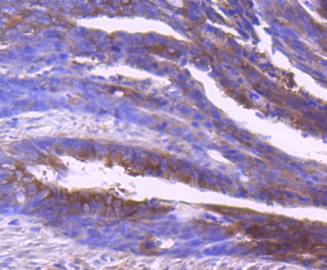 Immunohistochemical analysis of paraffin-embedded human colon carcinoma tissue using anti-Insulin degrading enzyme antibody. The section was pre-treated using heat mediated antigen retrieval with Tris-EDTA buffer (pH 9.0) for 20 minutes.The tissues were blocked in 1% BSA for 30 minutes at room temperature, washed with ddH2O and PBS, and then probed with the primary antibody (ET1701-97, 1/50) for 30 minutes at room temperature. The detection was performed using an HRP conjugated compact polymer system. DAB was used as the chromogen. Tissues were counterstained with hematoxylin and mounted with DPX.