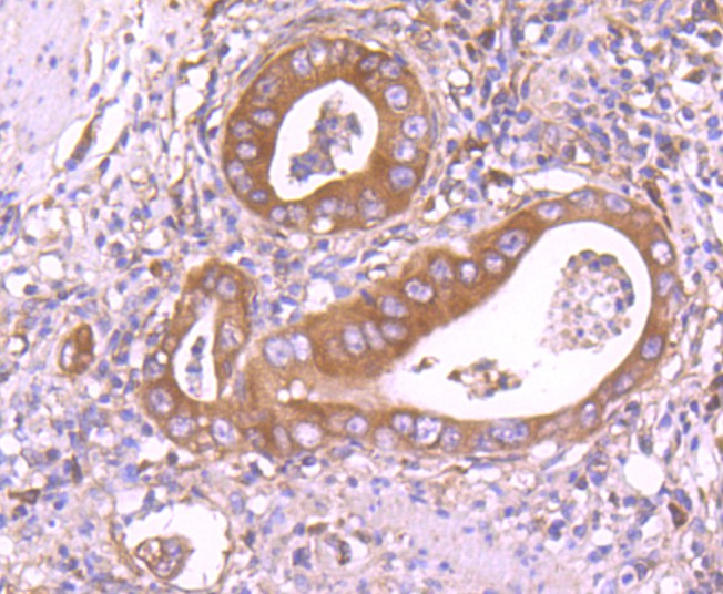 Immunohistochemical analysis of paraffin-embedded human stomach carcinoma tissue using anti-Insulin degrading enzyme antibody. The section was pre-treated using heat mediated antigen retrieval with Tris-EDTA buffer (pH 9.0) for 20 minutes.The tissues were blocked in 1% BSA for 30 minutes at room temperature, washed with ddH2O and PBS, and then probed with the primary antibody (ET1701-97, 1/50) for 30 minutes at room temperature. The detection was performed using an HRP conjugated compact polymer system. DAB was used as the chromogen. Tissues were counterstained with hematoxylin and mounted with DPX.
