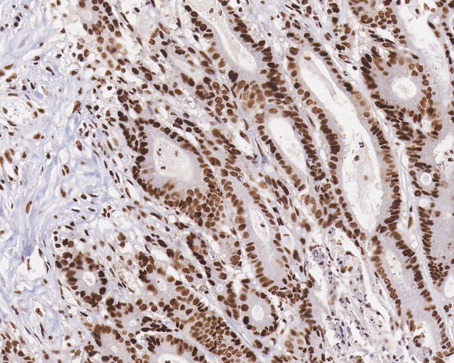 ICC staining of SP1 in SW480 cells (green). Formalin fixed cells were permeabilized with 0.1% Triton X-100 in TBS for 10 minutes at room temperature and blocked with 10% negative goat serum for 15 minutes at room temperature. Cells were probed with the primary antibody (ET1702-02, 1/50) for 1 hour at room temperature, washed with PBS. Alexa Fluor®488 conjugate-Goat anti-Rabbit IgG was used as the secondary antibody at 1/1,000 dilution. The nuclear counter stain is DAPI (blue).
