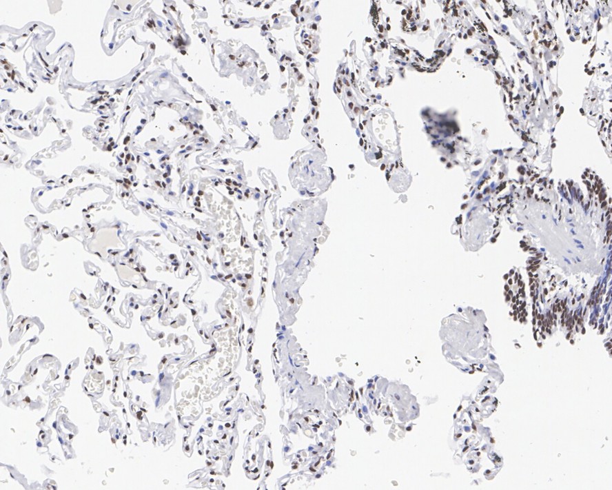 Immunohistochemical analysis of paraffin-embedded human breast carcinoma tissue using anti-SP1 antibody. The section was pre-treated using heat mediated antigen retrieval with Tris-EDTA buffer (pH 9.0) for 20 minutes.The tissues were blocked in 1% BSA for 30 minutes at room temperature, washed with ddH2O and PBS, and then probed with the primary antibody (ET1702-02, 1/50) for 30 minutes at room temperature. The detection was performed using an HRP conjugated compact polymer system. DAB was used as the chromogen. Tissues were counterstained with hematoxylin and mounted with DPX.