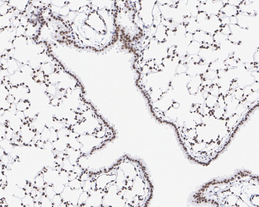 Immunohistochemical analysis of paraffin-embedded human colon carcinoma tissue using anti-SP1 antibody. The section was pre-treated using heat mediated antigen retrieval with Tris-EDTA buffer (pH 9.0) for 20 minutes.The tissues were blocked in 1% BSA for 30 minutes at room temperature, washed with ddH2O and PBS, and then probed with the primary antibody (ET1702-02, 1/50) for 30 minutes at room temperature. The detection was performed using an HRP conjugated compact polymer system. DAB was used as the chromogen. Tissues were counterstained with hematoxylin and mounted with DPX.