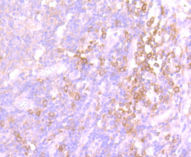 Immunohistochemical analysis of paraffin-embedded human breast carcinoma tissue using anti-Src antibody. The section was pre-treated using heat mediated antigen retrieval with Tris-EDTA buffer (pH 8.0-8.4) for 20 minutes.The tissues were blocked in 5% BSA for 30 minutes at room temperature, washed with ddH2O and PBS, and then probed with the primary antibody (ET1702-03, 1/50) for 30 minutes at room temperature. The detection was performed using an HRP conjugated compact polymer system. DAB was used as the chromogen. Tissues were counterstained with hematoxylin and mounted with DPX.