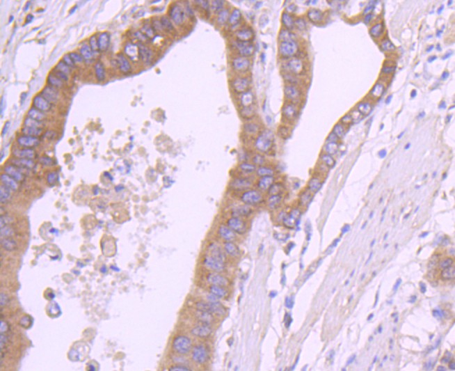 Immunohistochemical analysis of paraffin-embedded human stomach carcinoma tissue using anti-67kDa Laminin Receptor antibody. The section was pre-treated using heat mediated antigen retrieval with Tris-EDTA buffer (pH 9.0) for 20 minutes.The tissues were blocked in 1% BSA for 30 minutes at room temperature, washed with ddH2O and PBS, and then probed with the primary antibody (ET1702-05, 1/50) for 30 minutes at room temperature. The detection was performed using an HRP conjugated compact polymer system. DAB was used as the chromogen. Tissues were counterstained with hematoxylin and mounted with DPX.