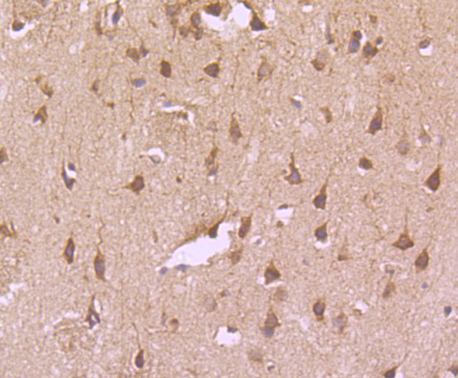 Immunohistochemical analysis of paraffin-embedded human lung carcinoma tissue using anti-Transferrin Receptor (CD71) antibody. The section was pre-treated using heat mediated antigen retrieval with Tris-EDTA buffer (pH 8.0-8.4) for 20 minutes.The tissues were blocked in 5% BSA for 30 minutes at room temperature, washed with ddH2O and PBS, and then probed with the primary antibody (ET1702-06, 1/50) for 30 minutes at room temperature. The detection was performed using an HRP conjugated compact polymer system. DAB was used as the chromogen. Tissues were counterstained with hematoxylin and mounted with DPX.
