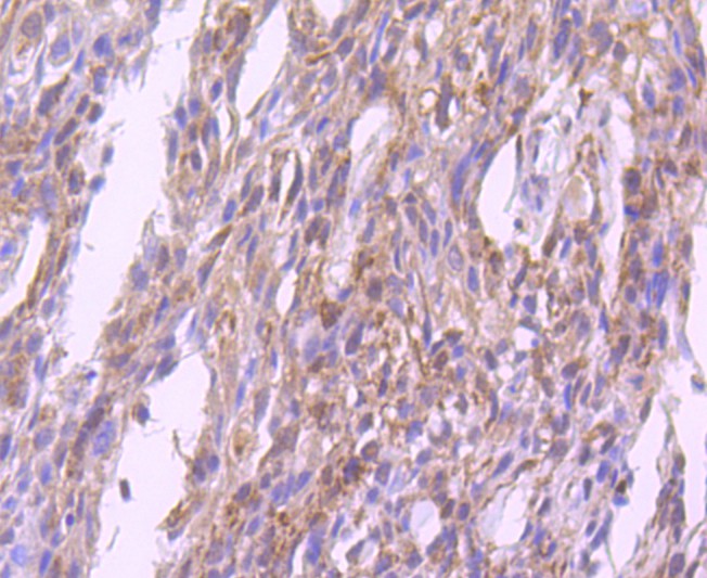 Immunohistochemical analysis of paraffin-embedded human breast carcinoma tissue using anti-Glutathione Peroxidase 1 antibody. Counter stained with hematoxylin.
