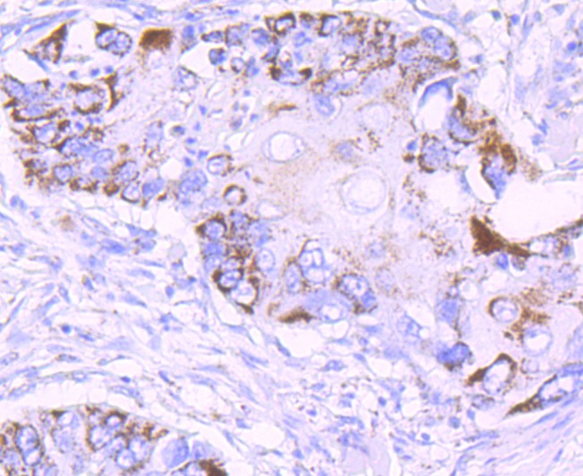 Immunohistochemical analysis of paraffin-embedded human lung carcinoma tissue using anti-MMP13 antibody. The section was pre-treated using heat mediated antigen retrieval with Tris-EDTA buffer (pH 8.0-8.4) for 20 minutes.The tissues were blocked in 5% BSA for 30 minutes at room temperature, washed with ddH2O and PBS, and then probed with the primary antibody (ET1702-14, 1/50) for 30 minutes at room temperature. The detection was performed using an HRP conjugated compact polymer system. DAB was used as the chromogen. Tissues were counterstained with hematoxylin and mounted with DPX.