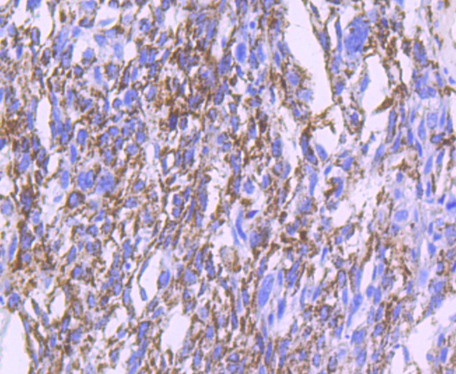 Immunohistochemical analysis of paraffin-embedded human breast tissue using anti-MMP13 antibody. The section was pre-treated using heat mediated antigen retrieval with Tris-EDTA buffer (pH 8.0-8.4) for 20 minutes.The tissues were blocked in 5% BSA for 30 minutes at room temperature, washed with ddH2O and PBS, and then probed with the primary antibody (ET1702-14, 1/50) for 30 minutes at room temperature. The detection was performed using an HRP conjugated compact polymer system. DAB was used as the chromogen. Tissues were counterstained with hematoxylin and mounted with DPX.
