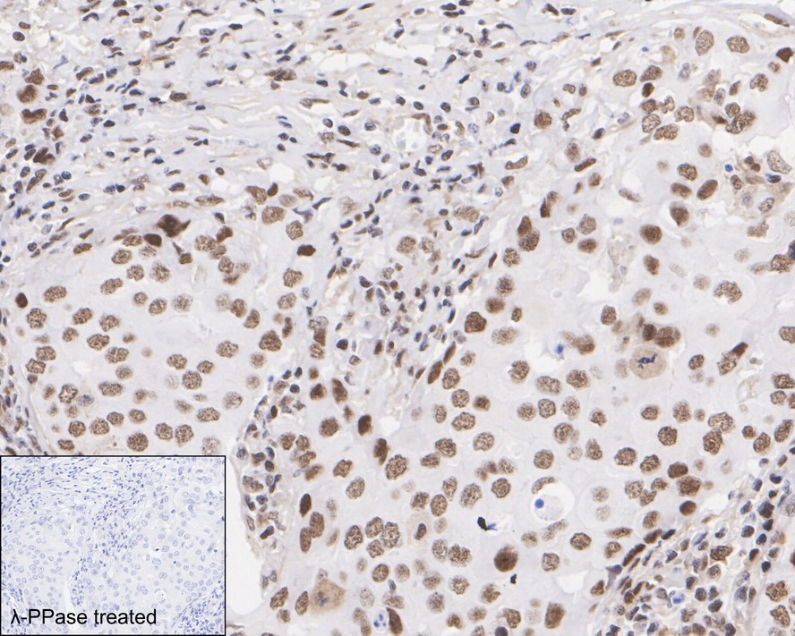 Immunohistochemical analysis of paraffin-embedded human breast carcinoma tissue using anti-Phospho-PKC alpha (T638) antibody. The section was pre-treated using heat mediated antigen retrieval with Tris-EDTA buffer (pH 8.0-8.4) for 20 minutes.The tissues were blocked in 5% BSA for 30 minutes at room temperature, washed with ddH2O and PBS, and then probed with the primary antibody (ET1702-17, 1/50) for 30 minutes at room temperature. The detection was performed using an HRP conjugated compact polymer system. DAB was used as the chromogen. Tissues were counterstained with hematoxylin and mounted with DPX.