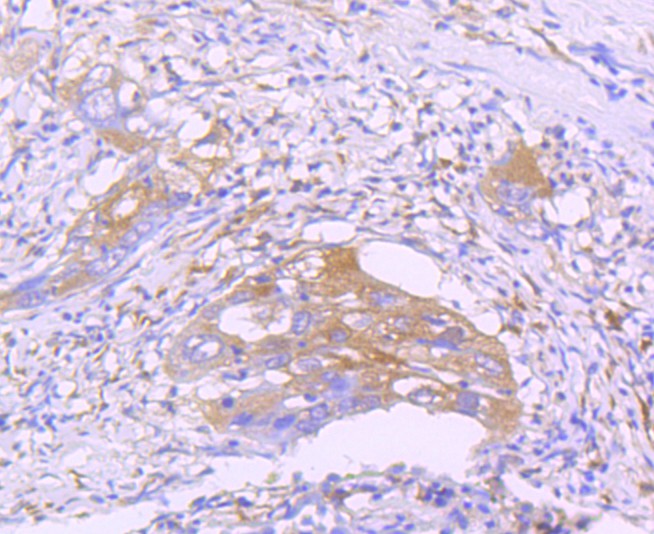 Immunohistochemical analysis of paraffin-embedded human lung cancer tissue with Rabbit anti-STAT2 antibody (ET1702-18) at 1/50 dilution.<br />
<br />
The section was pre-treated using heat mediated antigen retrieval with Tris-EDTA buffer (pH 9.0) for 20 minutes. The tissues were blocked in 1% BSA for 20 minutes at room temperature, washed with ddH2O and PBS, and then probed with the primary antibody (ET1702-18) at 1/400 dilution for 1 hour at room temperature. The detection was performed using an HRP conjugated compact polymer system. DAB was used as the chromogen. Tissues were counterstained with hematoxylin and mounted with DPX.