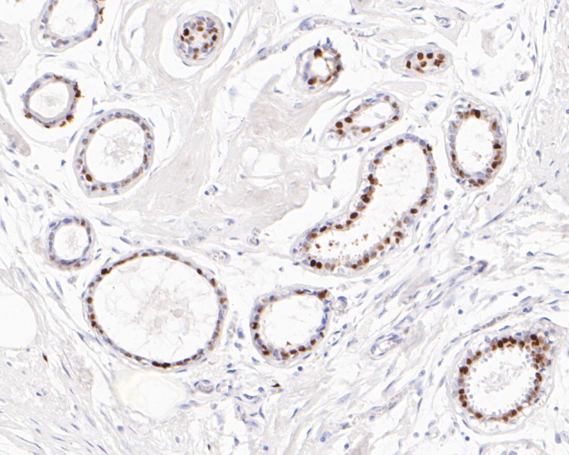Immunohistochemical analysis of paraffin-embedded human cervix tissue using anti-Progesterone Receptor antibody. The section was pre-treated using heat mediated antigen retrieval with sodium citrate buffer (pH 6.0) for 20 minutes. The tissues were blocked in 5% BSA for 30 minutes at room temperature, washed with ddH2O and PBS, and then probed with the primary antibody (ET1702-24, 1/50)  for 30 minutes at room temperature. The detection was performed using an HRP conjugated compact polymer system. DAB was used as the chromogen. Tissues were counterstained with hematoxylin and mounted with DPX.