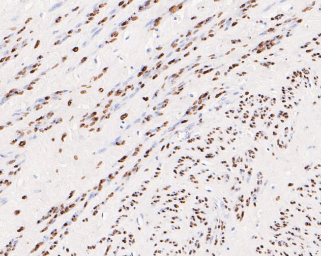 Immunohistochemical analysis of paraffin-embedded human uterus tissue using anti-Progesterone Receptor antibody. The section was pre-treated using heat mediated antigen retrieval with sodium citrate buffer (pH 6.0) for 20 minutes. The tissues were blocked in 5% BSA for 30 minutes at room temperature, washed with ddH2O and PBS, and then probed with the primary antibody (ET1702-24, 1/50)  for 30 minutes at room temperature. The detection was performed using an HRP conjugated compact polymer system. DAB was used as the chromogen. Tissues were counterstained with hematoxylin and mounted with DPX.