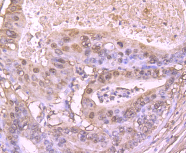 Immunohistochemical analysis of paraffin-embedded human stomach carcinoma tissue using anti-S100 alpha 6 antibody. The section was pre-treated using heat mediated antigen retrieval with Tris-EDTA buffer (pH 8.0-8.4) for 20 minutes.The tissues were blocked in 5% BSA for 30 minutes at room temperature, washed with ddH2O and PBS, and then probed with the primary antibody (ET1702-28, 1/50) for 30 minutes at room temperature. The detection was performed using an HRP conjugated compact polymer system. DAB was used as the chromogen. Tissues were counterstained with hematoxylin and mounted with DPX.