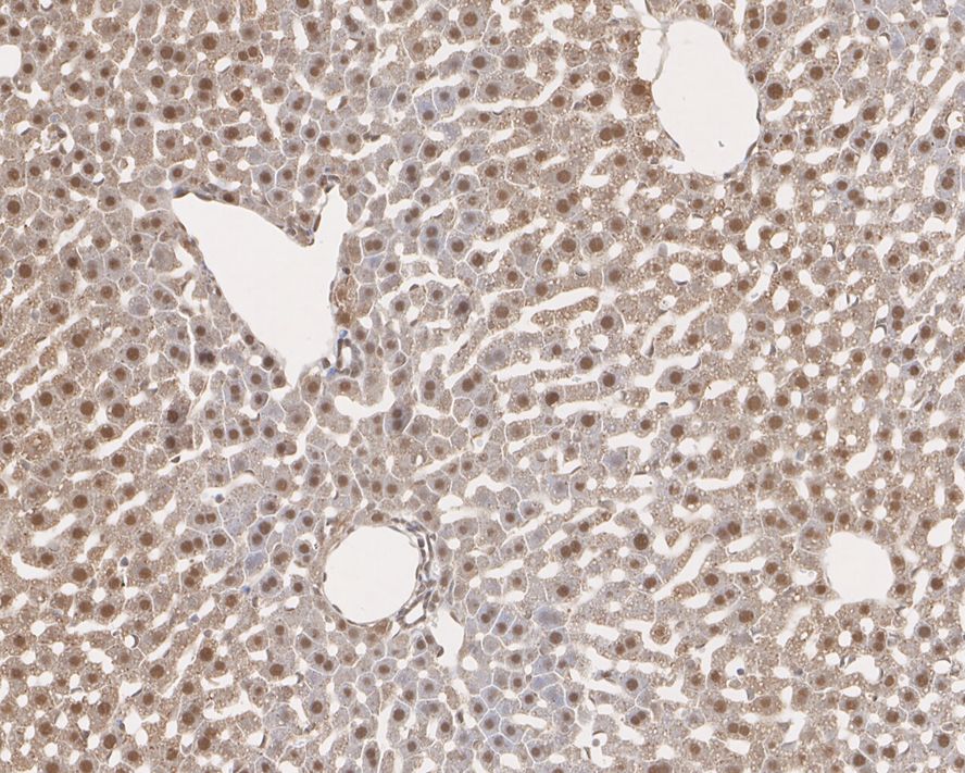 Immunohistochemical analysis of paraffin-embedded human liver tissue using anti-SOD1 antibody. Counter stained with hematoxylin.
