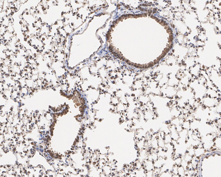 Immunohistochemical analysis of paraffin-embedded human breast carcinoma tissue using anti-SOD1 antibody. Counter stained with hematoxylin.
