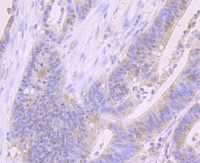 Immunohistochemical analysis of paraffin-embedded human colon carcinoma tissue using anti-FOXP1 antibody. The section was pre-treated using heat mediated antigen retrieval with Tris-EDTA buffer (pH 9.0) for 20 minutes.The tissues were blocked in 1% BSA for 30 minutes at room temperature, washed with ddH2O and PBS, and then probed with the primary antibody (ET1702-44, 1/50) for 30 minutes at room temperature. The detection was performed using an HRP conjugated compact polymer system. DAB was used as the chromogen. Tissues were counterstained with hematoxylin and mounted with DPX.