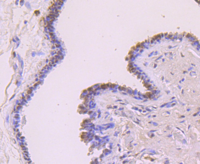 Immunohistochemical analysis of paraffin-embedded human breast carcinoma tissue using anti-FOXP1 antibody. The section was pre-treated using heat mediated antigen retrieval with Tris-EDTA buffer (pH 9.0) for 20 minutes.The tissues were blocked in 1% BSA for 30 minutes at room temperature, washed with ddH2O and PBS, and then probed with the primary antibody (ET1702-44, 1/50) for 30 minutes at room temperature. The detection was performed using an HRP conjugated compact polymer system. DAB was used as the chromogen. Tissues were counterstained with hematoxylin and mounted with DPX.