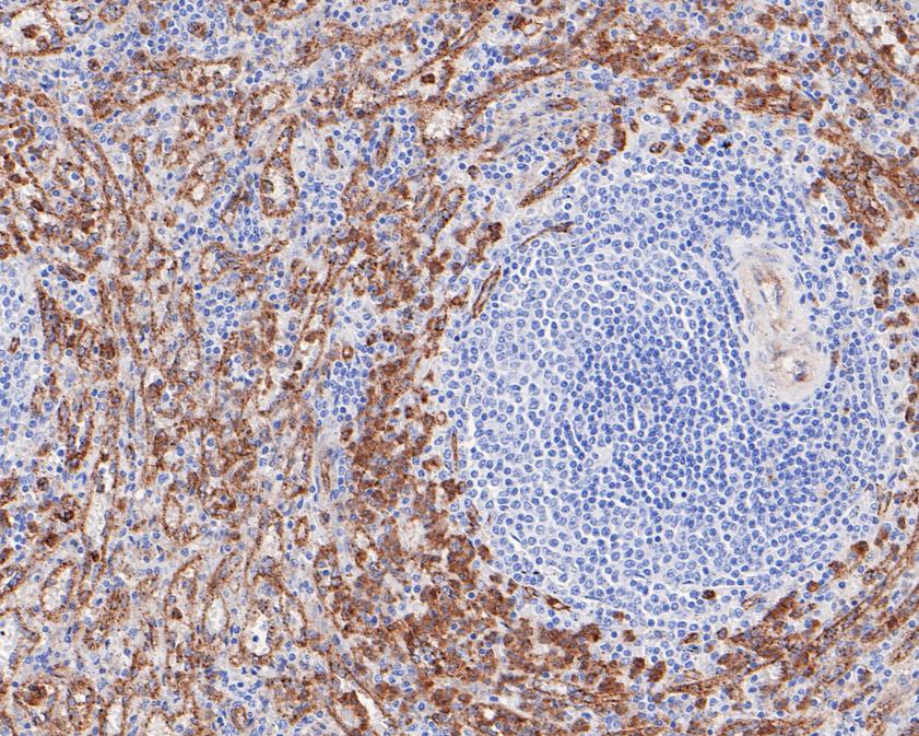 Immunohistochemical analysis of paraffin-embedded human spleen tissue using anti-Dysferlin antibody. The section was pre-treated using heat mediated antigen retrieval with Tris-EDTA buffer (pH 8.0-8.4) for 20 minutes.The tissues were blocked in 5% BSA for 30 minutes at room temperature, washed with ddH2O and PBS, and then probed with the primary antibody (ET1702-45, 1/50) for 30 minutes at room temperature. The detection was performed using an HRP conjugated compact polymer system. DAB was used as the chromogen. Tissues were counterstained with hematoxylin and mounted with DPX.