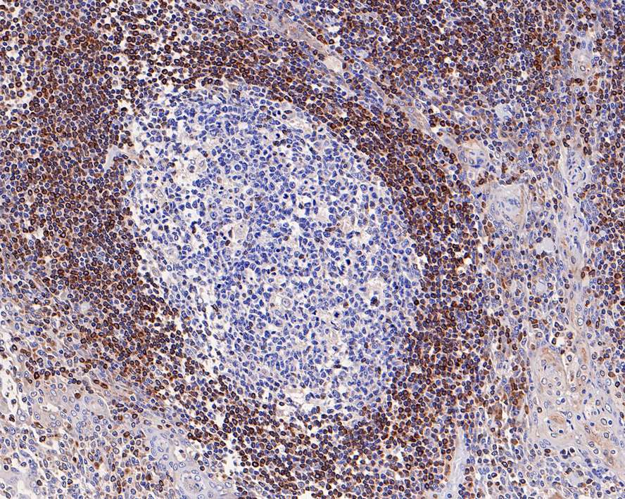 Immunohistochemical analysis of paraffin-embedded human tonsil tissue with Rabbit anti-Bcl-2 antibody (ET1702-53) at 1/5,000 dilution.<br />
<br />
The section was pre-treated using heat mediated antigen retrieval with Tris-EDTA buffer (pH 9.0) for 20 minutes. The tissues were blocked in 1% BSA for 20 minutes at room temperature, washed with ddH2O and PBS, and then probed with the primary antibody (ET1702-53) at 1/5,000 dilution for 1 hour at room temperature. The detection was performed using an HRP conjugated compact polymer system. DAB was used as the chromogen. Tissues were counterstained with hematoxylin and mounted with DPX.