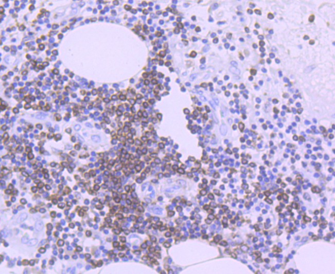 Immunohistochemical analysis of paraffin-embedded human colon carcinoma tissue using anti-Bcl-2 antibody. The section was pre-treated using heat mediated antigen retrieval with Tris-EDTA buffer (pH 8.0-8.4) for 20 minutes.The tissues were blocked in 5% BSA for 30 minutes at room temperature, washed with ddH2O and PBS, and then probed with the primary antibody (ET1702-53, 1/50) for 30 minutes at room temperature. The detection was performed using an HRP conjugated compact polymer system. DAB was used as the chromogen. Tissues were counterstained with hematoxylin and mounted with DPX.