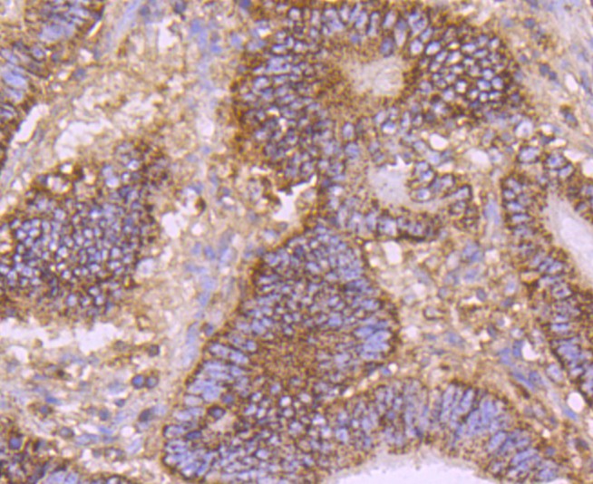 Immunohistochemical analysis of paraffin-embedded human colon carcinoma tissue using anti-CD147 antibody. The section was pre-treated using heat mediated antigen retrieval with Tris-EDTA buffer (pH 9.0) for 20 minutes.The tissues were blocked in 5% BSA for 30 minutes at room temperature, washed with ddH2O and PBS, and then probed with the primary antibody (ET1702-58, 1/50) for 30 minutes at room temperature. The detection was performed using an HRP conjugated compact polymer system. DAB was used as the chromogen. Tissues were counterstained with hematoxylin and mounted with DPX.