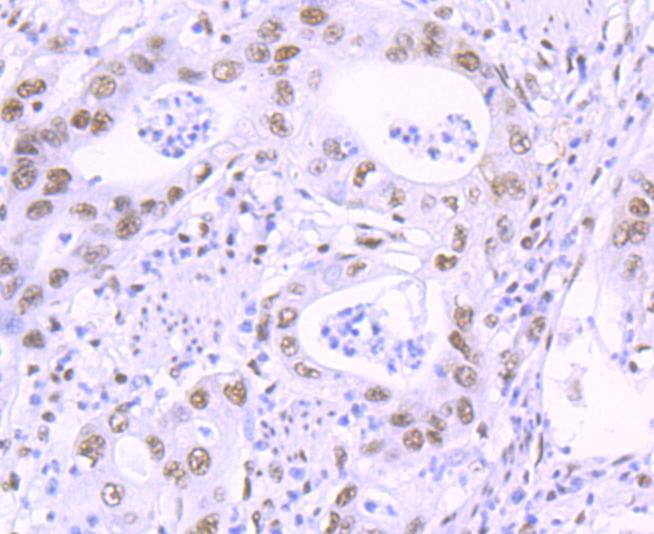 Immunohistochemical analysis of paraffin-embedded human stomach carcinoma tissue using anti-KLF4 antibody. The section was pre-treated using heat mediated antigen retrieval with Tris-EDTA buffer (pH 8.0-8.4) for 20 minutes.The tissues were blocked in 5% BSA for 30 minutes at room temperature, washed with ddH2O and PBS, and then probed with the primary antibody (ET1702-71, 1/50) for 30 minutes at room temperature. The detection was performed using an HRP conjugated compact polymer system. DAB was used as the chromogen. Tissues were counterstained with hematoxylin and mounted with DPX.