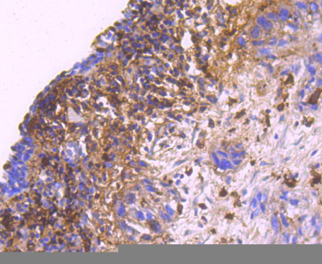 Immunohistochemical analysis of paraffin-embedded human lung carcinoma tissue using anti-S100A9 antibody. The section was pre-treated using heat mediated antigen retrieval with Tris-EDTA buffer (pH 9.0) for 20 minutes.The tissues were blocked in 1% BSA for 30 minutes at room temperature, washed with ddH2O and PBS, and then probed with the primary antibody (ET1702-73, 1/50) for 30 minutes at room temperature. The detection was performed using an HRP conjugated compact polymer system. DAB was used as the chromogen. Tissues were counterstained with hematoxylin and mounted with DPX.