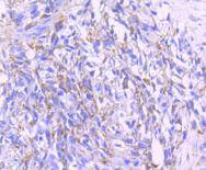 Immunohistochemical analysis of paraffin-embedded human breast carcinoma tissue using anti-PDHA1 antibody. The section was pre-treated using heat mediated antigen retrieval with Tris-EDTA buffer (pH 8.0-8.4) for 20 minutes.The tissues were blocked in 5% BSA for 30 minutes at room temperature, washed with ddH2O and PBS, and then probed with the primary antibody (ET1702-75, 1/50) for 30 minutes at room temperature. The detection was performed using an HRP conjugated compact polymer system. DAB was used as the chromogen. Tissues were counterstained with hematoxylin and mounted with DPX.