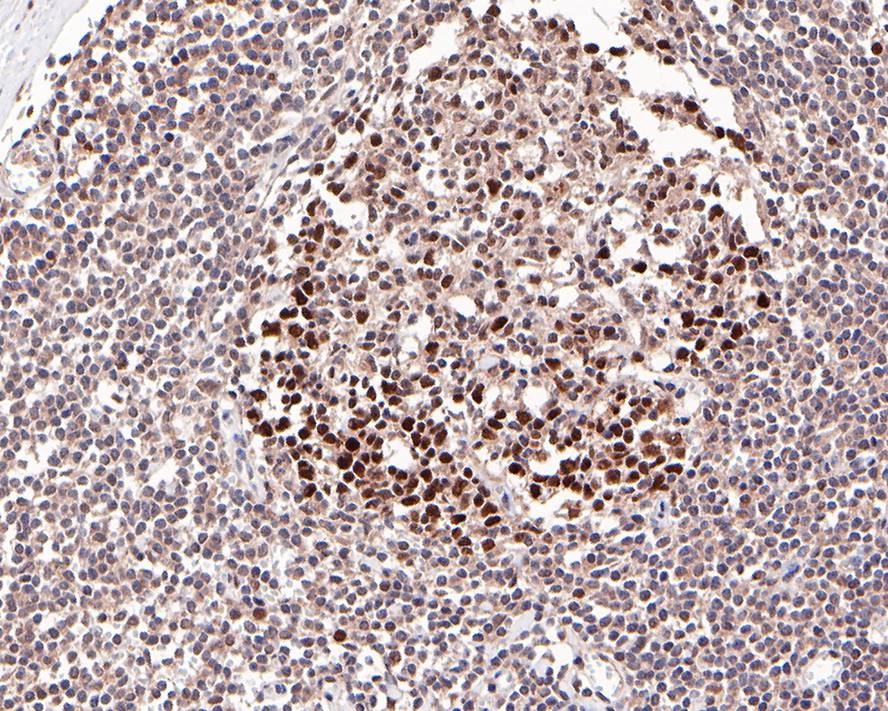 ICC staining of Dnmt1 in 293T cells (red). Formalin fixed cells were permeabilized with 0.1% Triton X-100 in TBS for 10 minutes at room temperature and blocked with 1% Blocker BSA for 15 minutes at room temperature. Cells were probed with the primary antibody (ET1702-77, 1/50) for 1 hour at room temperature, washed with PBS. Alexa Fluor®594 Goat anti-Rabbit IgG was used as the secondary antibody at 1/1,000 dilution. The nuclear counter stain is DAPI (blue).