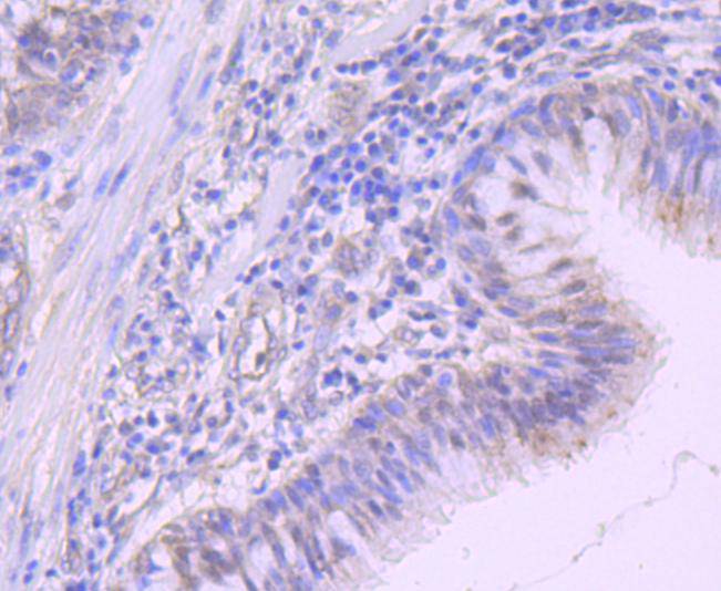 Immunohistochemical analysis of paraffin-embedded human breast carcinoma tissue using anti-NEDD8 antibody. The section was pre-treated using heat mediated antigen retrieval with sodium citrate buffer (pH 6.0) for 20 minutes. The tissues were blocked in 1% BSA for 30 minutes at room temperature, washed with ddH2O and PBS, and then probed with the primary antibody (ET1702-84, 1/50)  for 30 minutes at room temperature. The detection was performed using an HRP conjugated compact polymer system. DAB was used as the chromogen. Tissues were counterstained with hematoxylin and mounted with DPX.