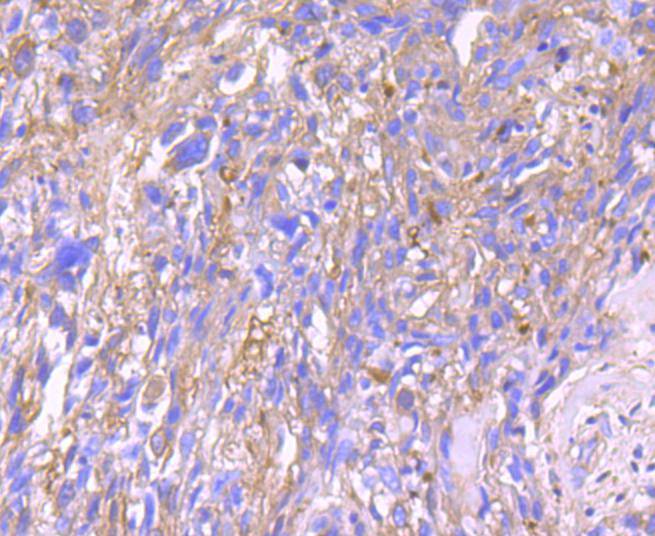 Immunohistochemical analysis of paraffin-embedded human breast carcinoma tissue using anti-alpha 1 Antitrypsin antibody. Counter stained with hematoxylin.