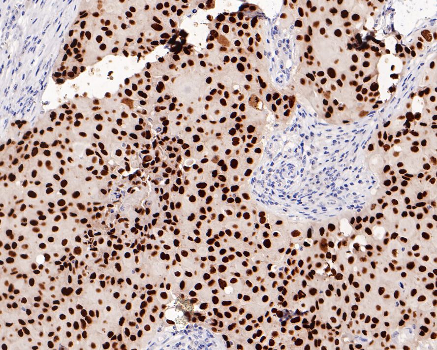 Immunohistochemical analysis of paraffin-embedded human breast carcinoma tissue with Rabbit anti-FOXA1 antibody (ET1702-89) at 1/1,000 dilution.<br />
<br />
The section was pre-treated using heat mediated antigen retrieval with sodium citrate buffer (pH 6.0) for 2 minutes. The tissues were blocked in 1% BSA for 20 minutes at room temperature, washed with ddH2O and PBS, and then probed with the primary antibody (ET1702-89) at 1/1,000 dilution for 1 hour at room temperature. The detection was performed using an HRP conjugated compact polymer system. DAB was used as the chromogen. Tissues were counterstained with hematoxylin and mounted with DPX.