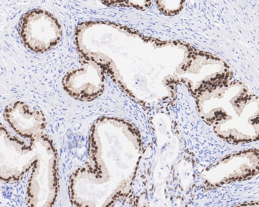 Immunohistochemical analysis of paraffin-embedded human prostate tissue with Rabbit anti-FOXA1 antibody (ET1702-89) at 1/500 dilution.<br />
<br />
The section was pre-treated using heat mediated antigen retrieval with sodium citrate buffer (pH 6.0) for 2 minutes. The tissues were blocked in 1% BSA for 20 minutes at room temperature, washed with ddH2O and PBS, and then probed with the primary antibody (ET1702-89) at 1/500 dilution for 1 hour at room temperature. The detection was performed using an HRP conjugated compact polymer system. DAB was used as the chromogen. Tissues were counterstained with hematoxylin and mounted with DPX.