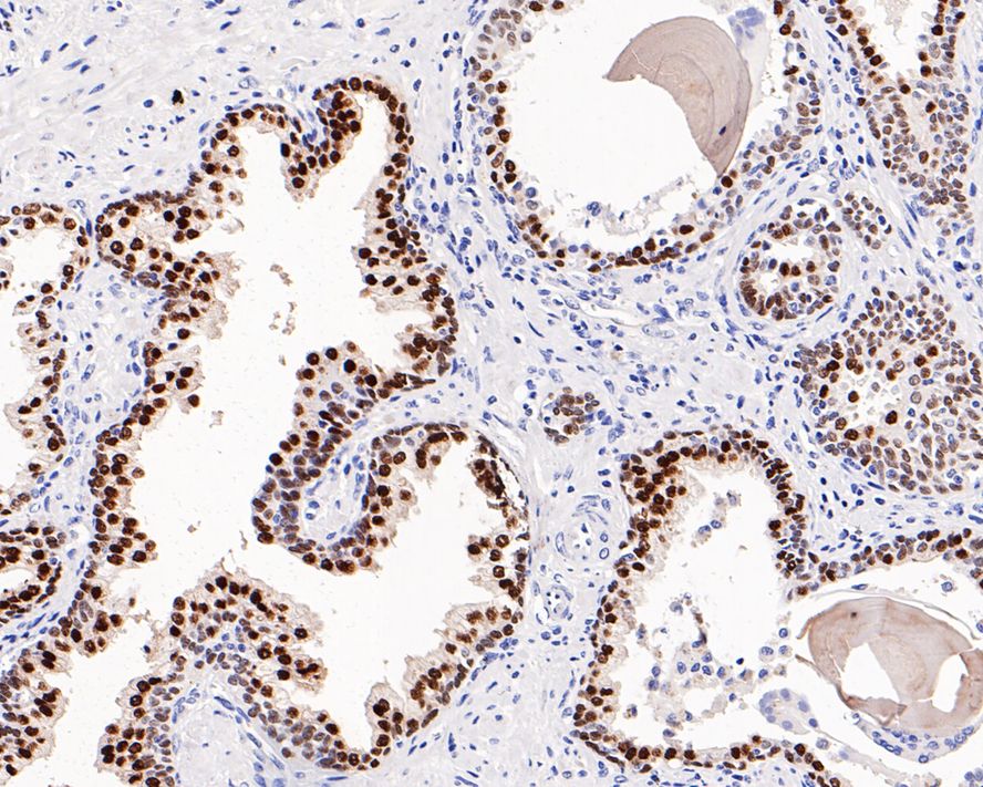Immunohistochemical analysis of paraffin-embedded human prostate carcinoma tissue with Rabbit anti-FOXA1 antibody (ET1702-89) at 1/1,000 dilution.<br />
<br />
The section was pre-treated using heat mediated antigen retrieval with sodium citrate buffer (pH 6.0) for 2 minutes. The tissues were blocked in 1% BSA for 20 minutes at room temperature, washed with ddH2O and PBS, and then probed with the primary antibody (ET1702-89) at 1/1,000 dilution for 1 hour at room temperature. The detection was performed using an HRP conjugated compact polymer system. DAB was used as the chromogen. Tissues were counterstained with hematoxylin and mounted with DPX.