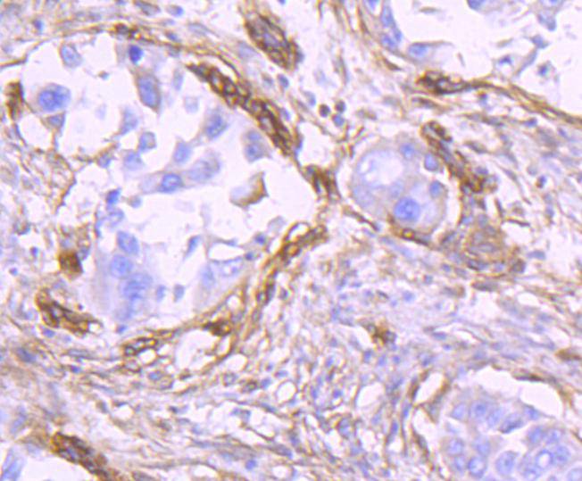 Immunohistochemical analysis of paraffin-embedded human lung carcinoma tissue using anti-THY1 antibody. The section was pre-treated using heat mediated antigen retrieval with Tris-EDTA buffer (pH 9.0) for 20 minutes.The tissues were blocked in 5% BSA for 30 minutes at room temperature, washed with ddH2O and PBS, and then probed with the primary antibody (ET1702-92, 1/50) for 30 minutes at room temperature. The detection was performed using an HRP conjugated compact polymer system. DAB was used as the chromogen. Tissues were counterstained with hematoxylin and mounted with DPX.