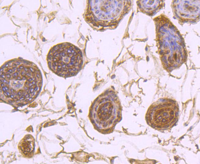 Immunohistochemical analysis of paraffin-embedded human liver carcinoma tissue using anti-SERCA2 antibody. The section was pre-treated using heat mediated antigen retrieval with Tris-EDTA buffer (pH 8.0-8.4) for 20 minutes.The tissues were blocked in 5% BSA for 30 minutes at room temperature, washed with ddH2O and PBS, and then probed with the primary antibody (ET1703-01, 1/50) for 30 minutes at room temperature. The detection was performed using an HRP conjugated compact polymer system. DAB was used as the chromogen. Tissues were counterstained with hematoxylin and mounted with DPX.