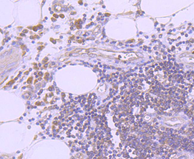 Immunohistochemical analysis of paraffin-embedded human colon cancer tissue using anti-K63-linkage Specific Ubiquitin antibody. Counter stained with hematoxylin.