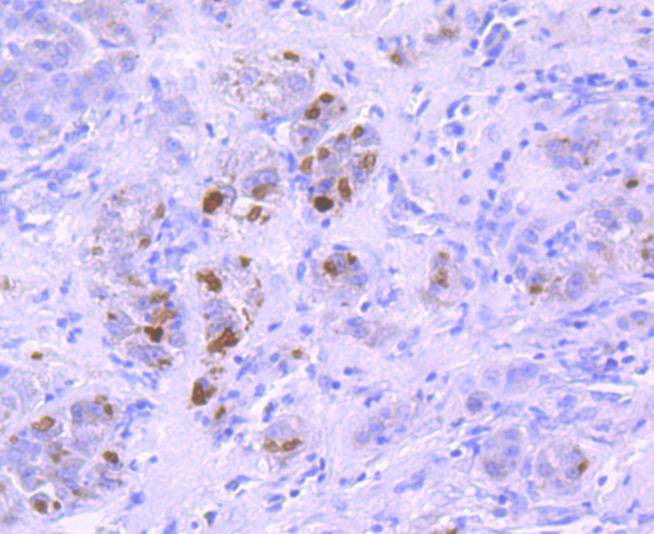 Immunohistochemical analysis of paraffin-embedded human liver cancer tissue using anti-K63-linkage Specific Ubiquitin antibody. Counter stained with hematoxylin.