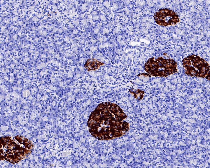 Immunohistochemical analysis of paraffin-embedded human pancreas tissue with Rabbit anti-Chromogranin A antibody (ET1703-08) at 1/200 dilution.<br />
<br />
The section was pre-treated using heat mediated antigen retrieval with Tris-EDTA buffer (pH 9.0) for 20 minutes. The tissues were blocked in 1% BSA for 20 minutes at room temperature, washed with ddH2O and PBS, and then probed with the primary antibody (ET1703-08) at 1/200 dilution for 1 hour at room temperature. The detection was performed using an HRP conjugated compact polymer system. DAB was used as the chromogen. Tissues were counterstained with hematoxylin and mounted with DPX.