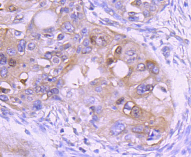 Immunohistochemical analysis of paraffin-embedded human lung carcinoma tissue using anti-Ezrin antibody. The section was pre-treated using heat mediated antigen retrieval with Tris-EDTA buffer (pH 8.0-8.4) for 20 minutes.The tissues were blocked in 5% BSA for 30 minutes at room temperature, washed with ddH2O and PBS, and then probed with the primary antibody (ET1703-25, 1/50) for 30 minutes at room temperature. The detection was performed using an HRP conjugated compact polymer system. DAB was used as the chromogen. Tissues were counterstained with hematoxylin and mounted with DPX.