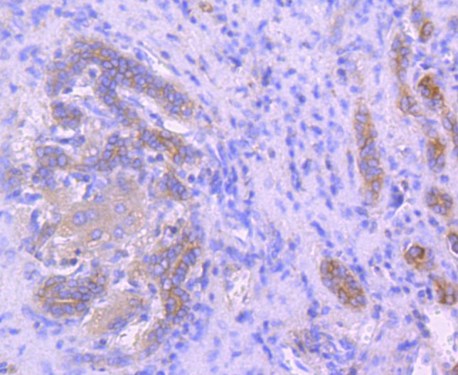 Immunohistochemical analysis of paraffin-embedded human liver carcinoma tissue using anti-Ezrin antibody. The section was pre-treated using heat mediated antigen retrieval with Tris-EDTA buffer (pH 8.0-8.4) for 20 minutes.The tissues were blocked in 5% BSA for 30 minutes at room temperature, washed with ddH2O and PBS, and then probed with the primary antibody (ET1703-25, 1/50) for 30 minutes at room temperature. The detection was performed using an HRP conjugated compact polymer system. DAB was used as the chromogen. Tissues were counterstained with hematoxylin and mounted with DPX.