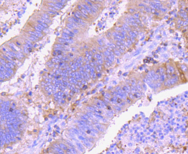 Immunohistochemical analysis of paraffin-embedded human colon carcinoma tissue using anti-Ezrin antibody. The section was pre-treated using heat mediated antigen retrieval with Tris-EDTA buffer (pH 8.0-8.4) for 20 minutes.The tissues were blocked in 5% BSA for 30 minutes at room temperature, washed with ddH2O and PBS, and then probed with the primary antibody (ET1703-25, 1/50) for 30 minutes at room temperature. The detection was performed using an HRP conjugated compact polymer system. DAB was used as the chromogen. Tissues were counterstained with hematoxylin and mounted with DPX.